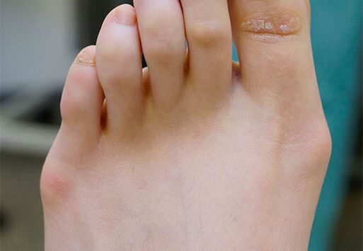 Foot Valgus