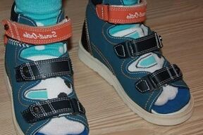 noszenie sandałów na paluch koślawy u dziecka