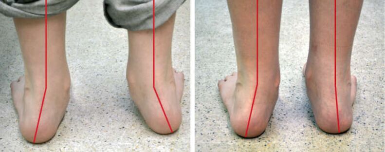 Nogi Valgus